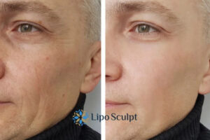 How to Fight Aging Symptoms 3 Fight Aging Symptoms Stirling With HIFU and Morpheus8 Today!
