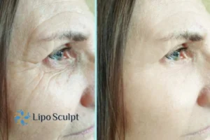 How to Fight Aging Symptoms 2 Do you want to Fight Aging Symptoms Stirling? Contact Lipo Sculpt today!
