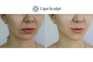 Explaining Total Skin Tightening Treatment And What It Can Do For You 2 Do you want to boost your self confidence? Give Morpheus8 Stirling a try today!