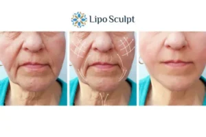 Explaining Total Skin Tightening Treatment And What It Can Do For You 3 Boost your confidence with Morpheus8 Stirling call our team today!