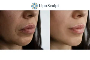 Explaining Total Skin Tightening Treatment And What It Can Do For You 4 Morpheus8 Stirling the best results - call our team today!