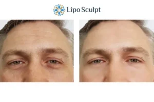 Explaining Total Skin Tightening Treatment And What It Can Do For You 6 Morpheus8 Stirling book in today to find out more!