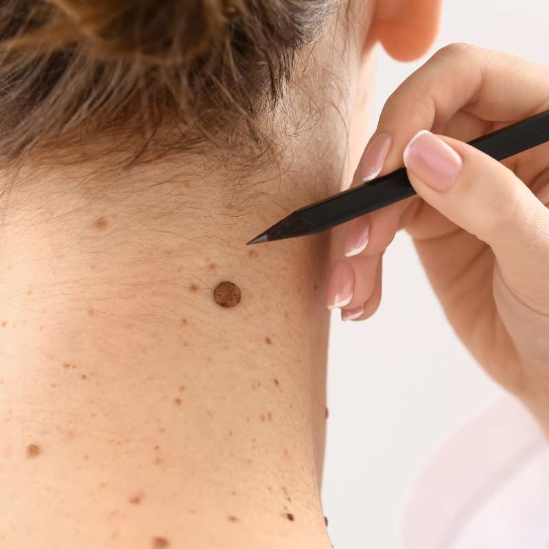 benign mole removal