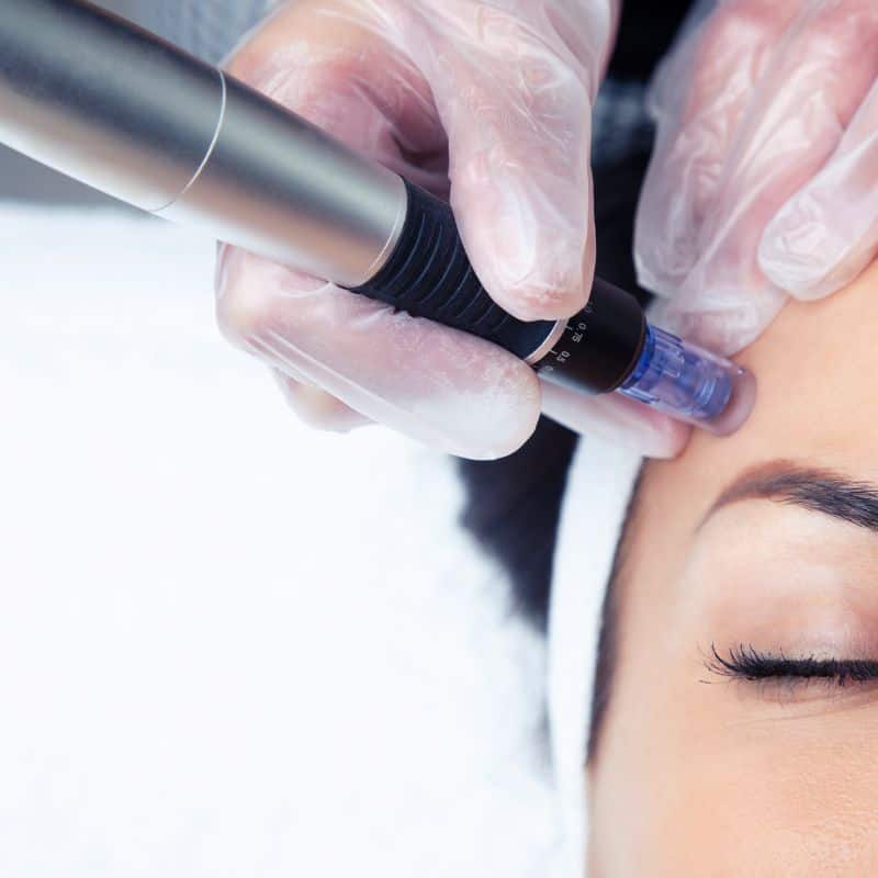 Morpheus8 treatment Stirling from Lipo Sculpt - Book in today!