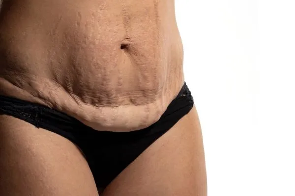Lost the Weight but Not the Loose Skin? 1 image of womans stomach after weight loss showing loose skin Stirling